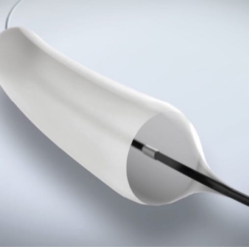 GIE Medical Launches Two Clinical Trials to Investigate Use of a Multi-Stage Drug Coated Balloon in Esophageal and Bowel Strictures